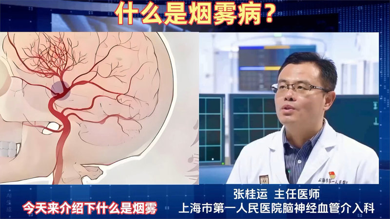 什么是烟雾病？