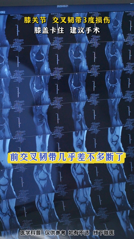 膝关节韧带损伤要不要手术？