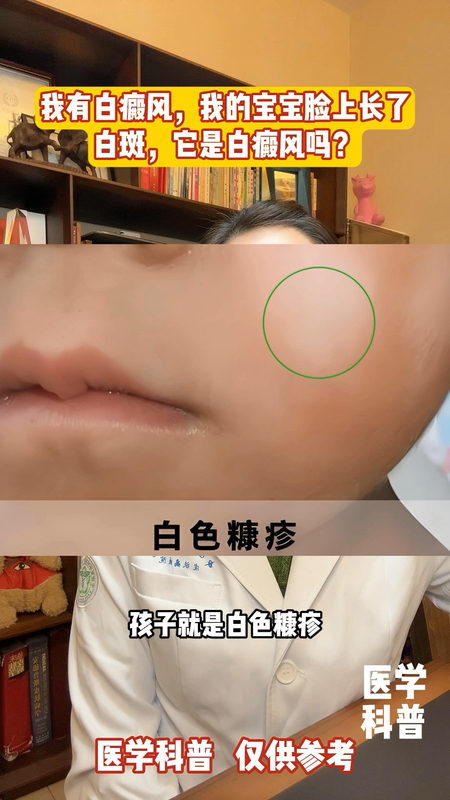 我有白癜风，我的宝宝脸上长了白斑，会是白癜风吗？