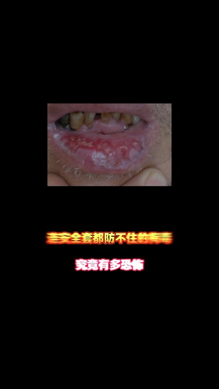 梅毒究竟有多恐怖