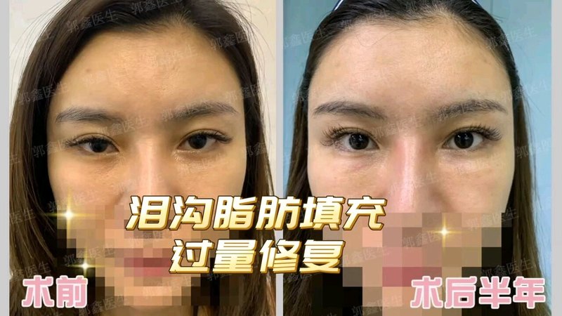 泪沟脂肪填充过量修复术后半年分享