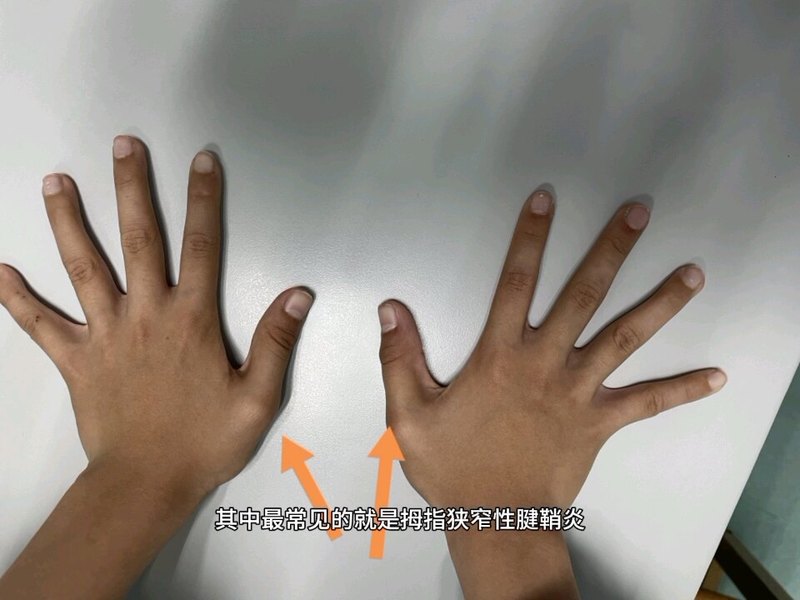 大拇指伸不直