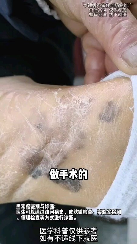 脚上长这种黑痣一定及时去医院，很可能是黑素瘤！