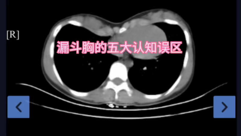 漏斗胸的五大认知误区！