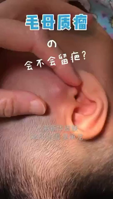 很容易被误诊为蚊子块、血管瘤的毛母质瘤，建议早期切除