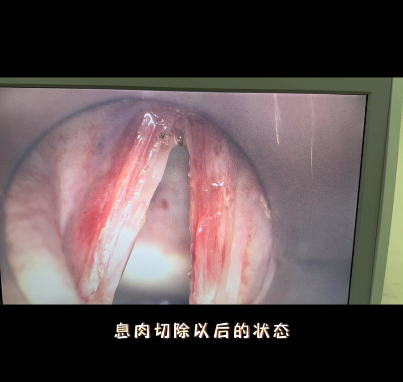 声带息肉，精细手术需要高端设备