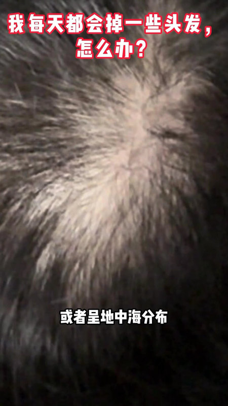 每天都会掉一些头发怎么办？