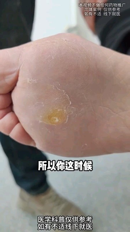 脚底长老茧怎么办？