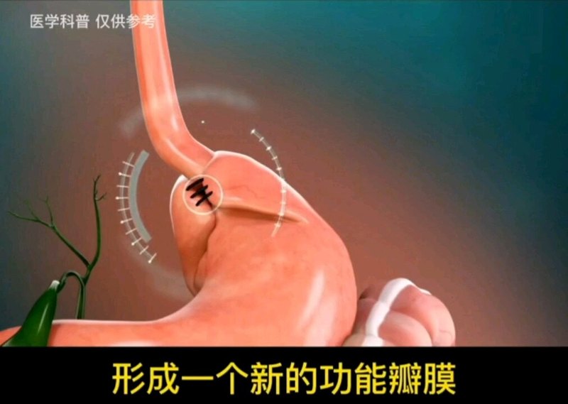 腹腔镜下胃底折叠术【动画】
