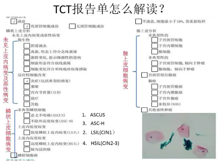 TCT报告单解读（一）
