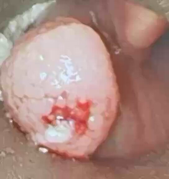 咽部乳头状瘤需要根治