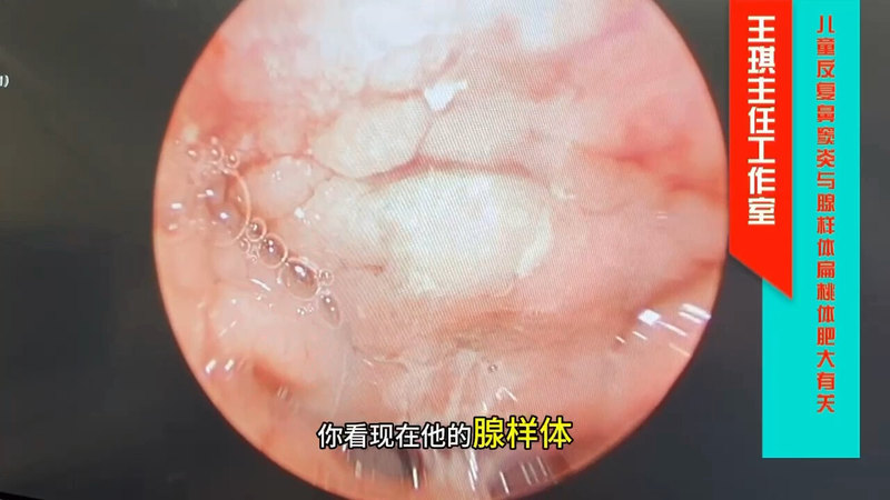 腺样体扁桃体肥大所致慢性鼻窦炎