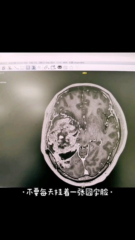 巨大脑胶质瘤：扩大切除肿瘤后，头疼症状消失～