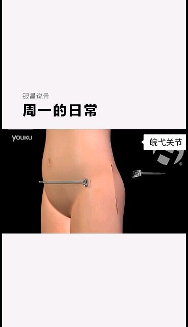 全髋关节假体置换动画