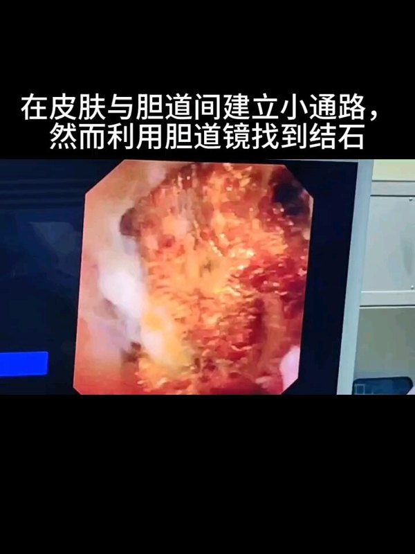 经皮经肝胆道镜取石术实例二