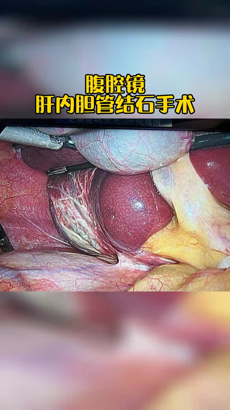 腹腔镜肝内胆管结石手术
