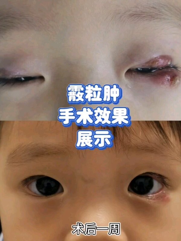 霰粒肿手术效果怎么样？