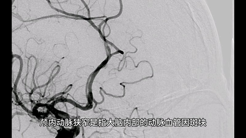 颅内动脉狭窄，早发现，可防可治