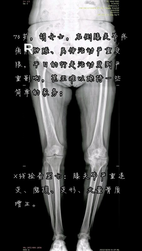 人工膝关节置换解除老年关节病痛，恢复健康快乐生活！