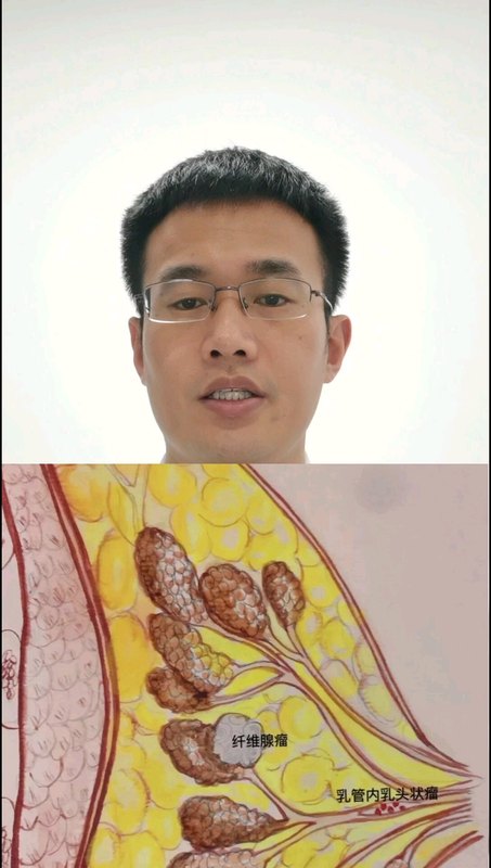 乳腺导管内乳头状瘤
