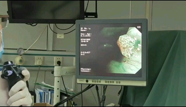 其实咽喉部乳头状瘤切除很简单