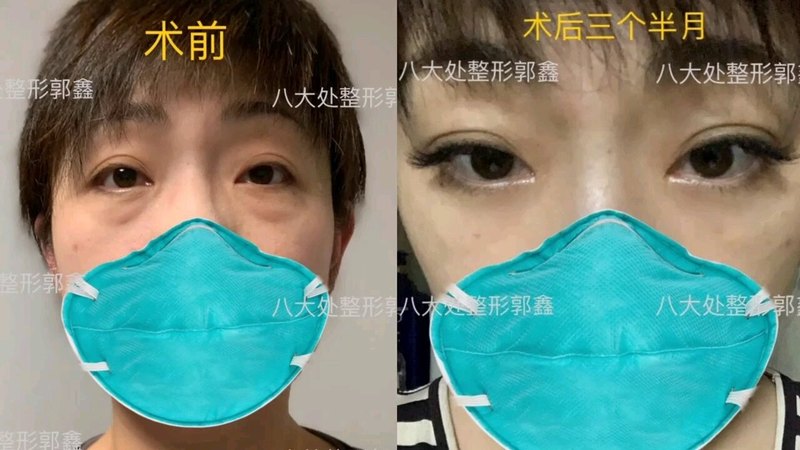 内切去眼袋填泪沟术后三个半月分享