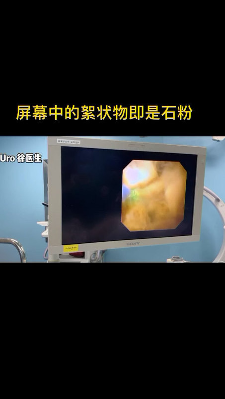 将肾结石粉身碎骨，视频如下