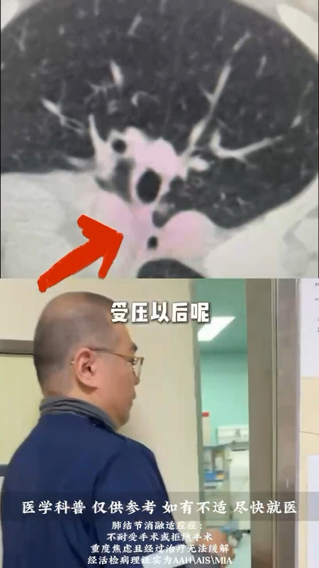 靶扫描是个什么检查，为何消融前要建议做靶扫描
