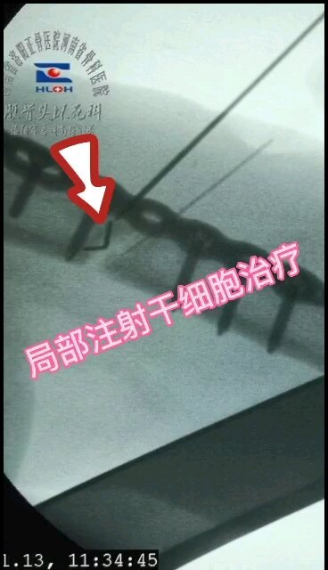 干细胞+冲击波：骨折不愈合