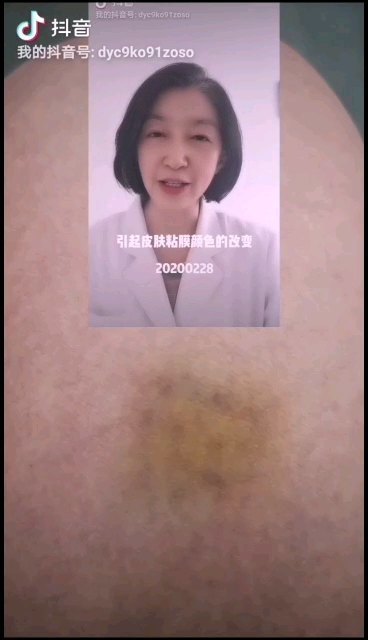 腿青了一块是咋回事呀？