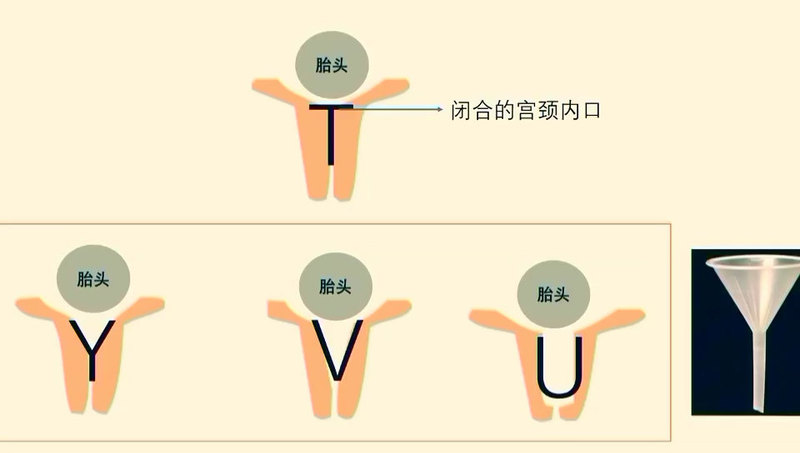 什么是“宫颈漏斗”？什么是“T”形、“Y”形、“V”形及“U”形宫颈？